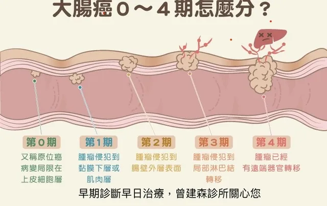 大腸癌分期：從0期到4期的完整解析